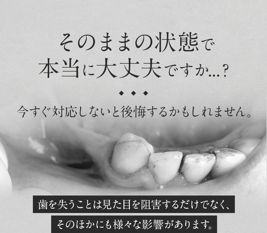 そのままの状態で本当に大丈夫ですか…？今すぐ対応しないと後悔するかもしれません。歯を失うことほあ見た目を阻害するだけでなく、その他にも様々な影響があります。
