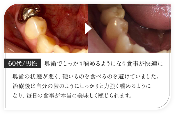 60代男性/奥歯でしっかり噛めるようになり食事が快適に