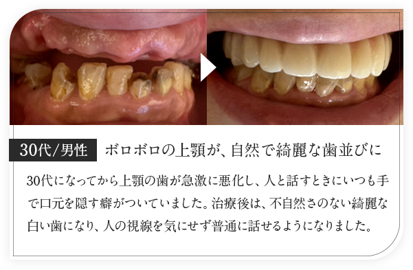 30代男性/ボロボロの上顎が、自然で綺麗な歯並びに