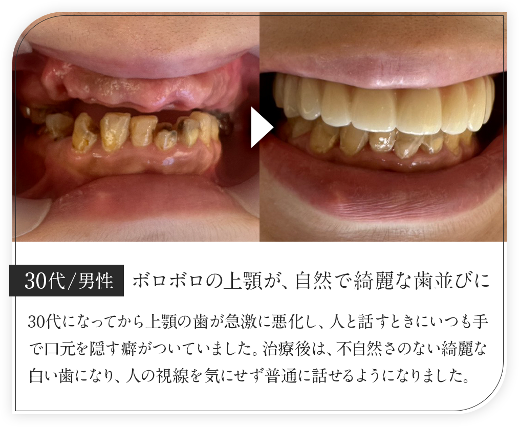 30代男性/ボロボロの上顎が、自然で綺麗な歯並びに